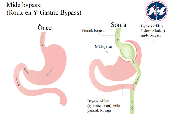 Mide Bypassı (Roux-en Y Gastric Bypass)