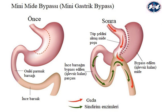 Mini Mide Bypassı (Mini Gastrik Bypass)