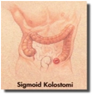 sigmoid-kolostomi