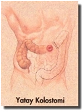 yatay-kolostomi