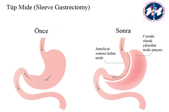 Tüp Mide (Sleeve Gastrectomy)